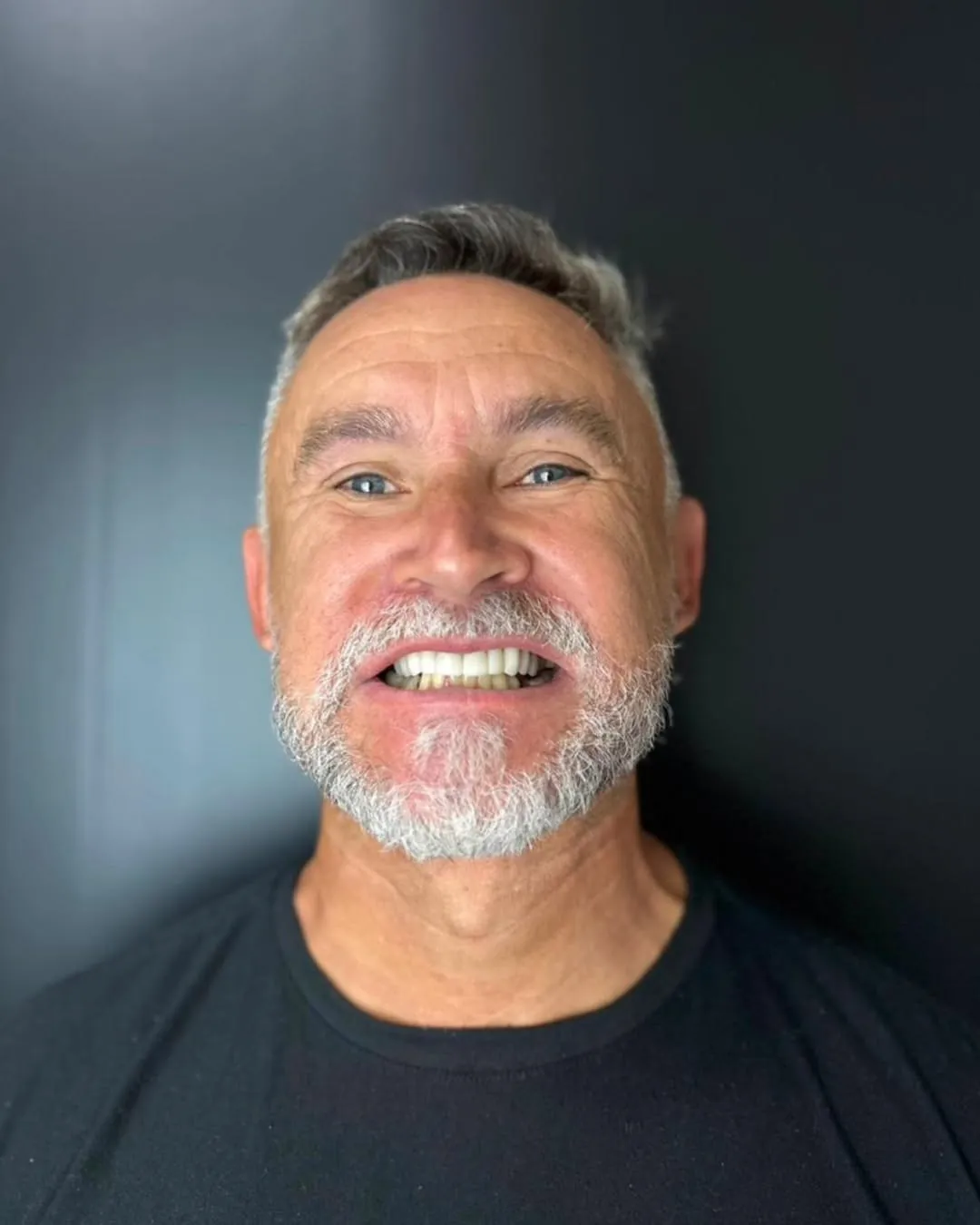 Caso real Feitoodonto — facetas dentárias